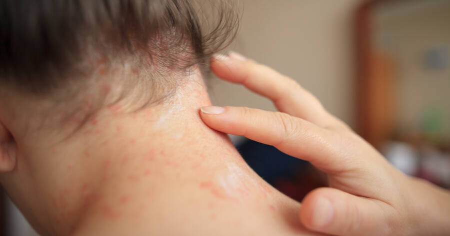 Early Signs of Eczema? Explore New Treatment Options